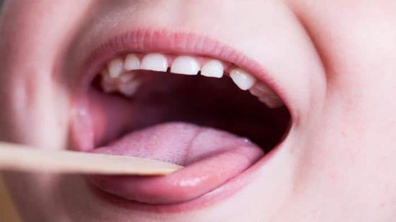 علاج فطريات الفم عند الأطفال حسب العمر