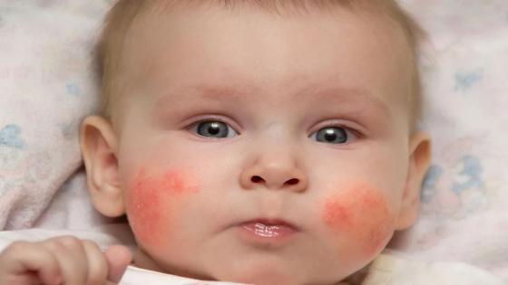 كريم حساسية الوجه عند الرضع
